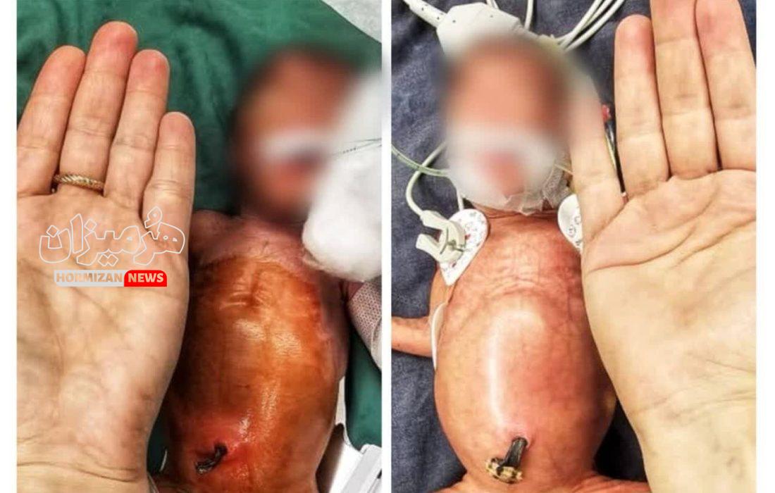 جراحی نجات بخش پارگی روده دوقلوهای نارس در بیمارستان کودکان بندرعباس