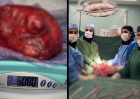 جراحی و خارج‌سازی فیبروم ۶ کیلوگرمی در بیمارستان شریعتی بندرعباس